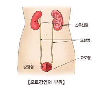 요로 감염 [출처: 서울아산병원]