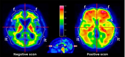 듀켐바이오 방사성의약품 ‘비자밀’로 베타 아밀로이드 분포를 컬러 영상으로 나타낸 모습이다. (왼쪽)Negative scan(음성 스캔), (오른쪽)Positive scan(양성 스캔)으로 푸른색과 초록색은 베타 아밀로이드 밀도가 낮음을, 주황색 붉은색은 밀도가 높음을 의미한다. (자료=듀켐바이오)