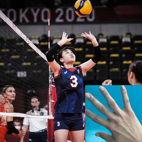 염혜선의 2020 도쿄 올림픽 모습. 작은 사진은 도쿄 올림픽을 마친 뒤 염혜선의 왼 손바닥. 약지는 인대 파열 등의 부상 후유증으로 뼈가 튀어나와 있고, 새끼손가락 아래 수술 자국은 손등뼈 골절로 인해 핀이 박혀 있는 상태로 올림픽에 출전했다. 사진=FIVB