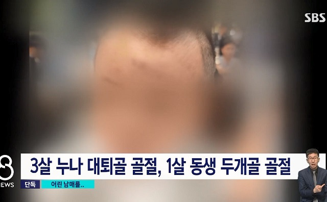 두개골 골절상을 입고 수술받은 1세 남아. SBS 보도화면 캡처