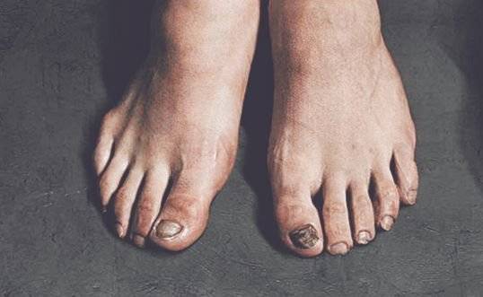 손흥민 키는 1m83㎝로 큰 편인데, 발사이즈는 255~260㎜ 중간 정도다. 손흥민이 작다 싶을 만큼 꼭 끼는 축구화를 신는 데는 이유가 있다. 미세한 감각까지 온전히 다 느끼기 위해서다. 손흥민의 이전 발 사진을 보면 발톱 일부가 빠져 시커멓게 멍들어 있다. 발뒤꿈치는 까진 상태다. 중앙포토