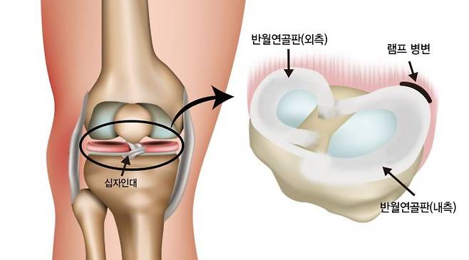 무릎 십자인대 및 반월연골판 구조.[자료=강동경희대병원]