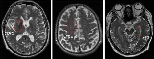 "'뇌혈관 주위 공간확장' 심할수록 알츠하이머 진행 빨라" [상계백병원 제공]