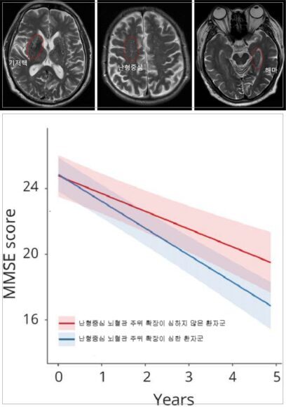 기저핵, 난형중심, 해마 부위 뇌혈관 주위 공간 확장이 심한 환자의 뇌 MRI 영상(위)과 난형중심 부위 뇌혈관 주위 공간 확장 정도가 심한 환자군(파란선)과 그렇지 않은 환자군(붉은색)의 인지점수 저하 속도 비교(아래). [자료=인제대 상계백병원]
