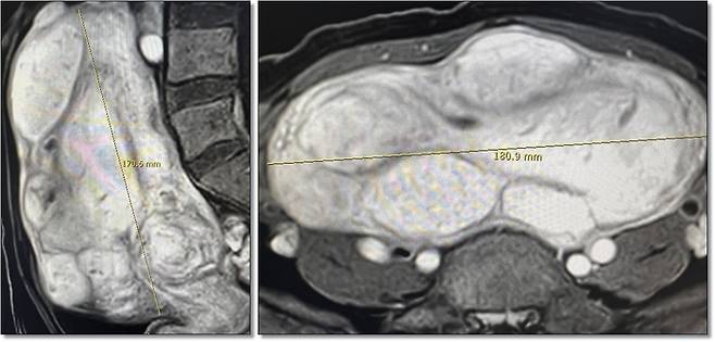 다발성 및 거대자궁근종으로 진단받은 A씨의 MRI영상