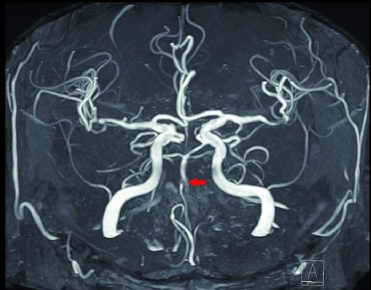 미니 뇌졸중을 경험한 환자의 뇌 자기공명영상(MRI) 사진. 붉은 화살표로 표시된 부위 뇌혈관이 막혀 끊긴 것처럼 보인다. 고려대 구로병원 제공