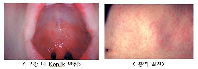 홍역 증상/미국 CDC, 질병관리청 제공