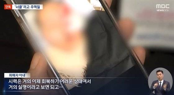 너클 낀 주먹에 폭행 당한 B씨는 실명 위기에 처한 것으로 알려졌다. [사진출처 = MBC 보도 영상 캡처]