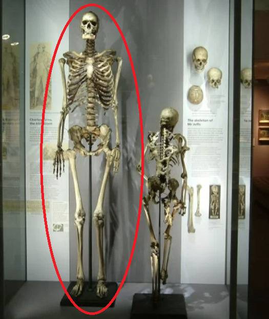 전시 중인 찰스 번의 유골 [사진 = 아일랜드 왕립내과대학]