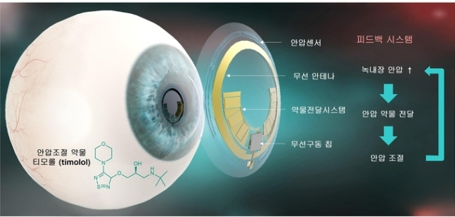 녹내장의 안압 진단 센서 및 안압 조절용 유연성 약물전달시스템이 장착된 무선 구동 '테라노스틱(theranostic) 스마트 콘택트렌즈' 모식도. [그래픽=포항공대 제공]