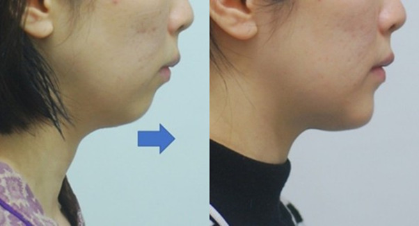 턱끝 전진술은 '살을 당기는' 수술이다. 턱끝을 9mm 앞으로 당기면 턱선과 목선이 팽팽하게 당겨진다.