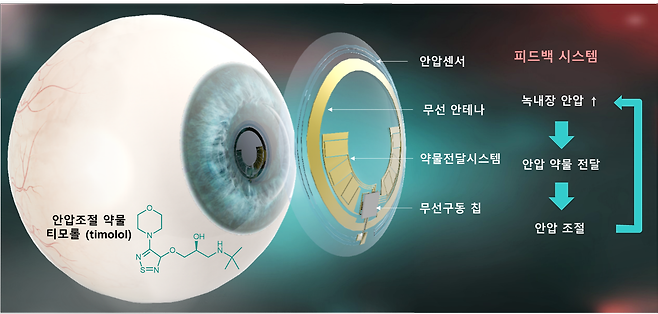 포스텍 연구팀이 개발한 스마트 콘택트렌즈. /포스텍