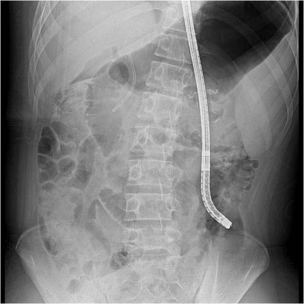 괴사성 췌장염 환자의 내시경적 괴사제거술 과정을 찍은 X-선 촬영물. /사진=한림대 동탄성심병원