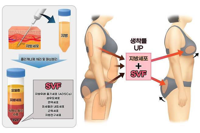 SVF 추출 방법 및 구성 요소(왼쪽), SVF 지방이식을 통한 체형 교정(오른쪽)