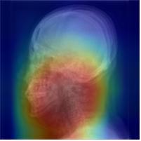 두경부 엑스레이 영상을 활용한 수면무호흡증 진단 예시. 딥러닝 알고리즘이 수면무호흡증 여부를 분류하는 이미지 상 특이점의 위치(붉은색)를 확인할 수 있다./분당서울대병원 제공
