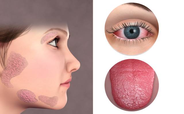 외분비기관에 나타나는 쇼그렌증후군의 증상 모습. 디자인=뉴미디어영상부