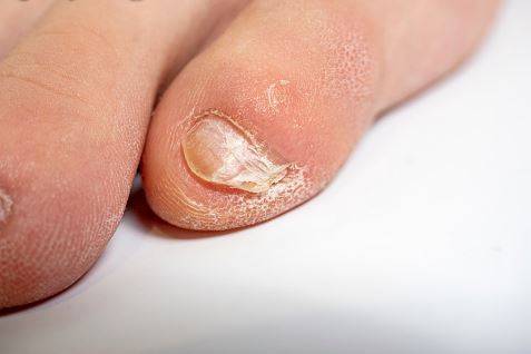 새끼발톱 갈라짐은 민족, 인종과는 관계가 없고 불편함을 초래한다면 제거 수술을 받을 수 있다./사진=게티이미지뱅크
