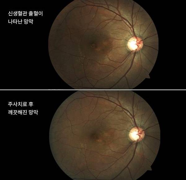 출처: 비앤빛강남밝은세상안과