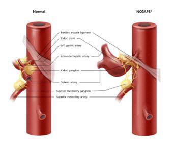 호두까기복통이 있는 경우(오른쪽) 정상인 왼쪽과 달리 정중궁인대가 복강동맥(Celiac Trunk)을 가로지르며 복강신경절을 눌러 통증을 유발한다. 삼성서울병원 제공