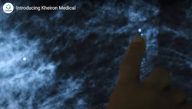 유방암 진단 AI를 활용해 유방 X선 사진을 분석하는 모습 [헝가리 케이론 메디컬 테크놀로지스 홈페이지 영상 캡처. 재판매 및 DB 금지]