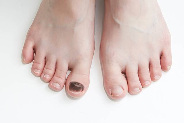 발톱 멍은 운동 후 조깅 발톱일 수 있지만, 시간이 지나도 사라지지 않으면 다른 질환을 의심해야 한다./사진=클립아트코리아