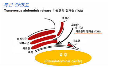 복벽 재건을 위해 복벽의 3개의 근육층 가운데 가장 안쪽에 위치한 가로근을 절개한 가로근막 절개술.