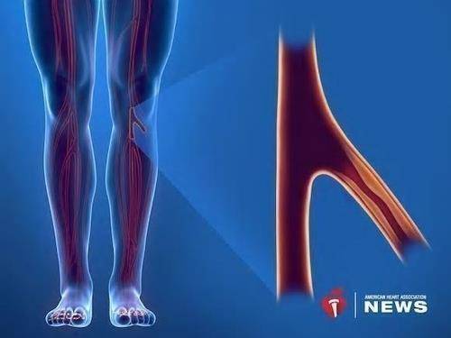 말초동맥 질환(PAD) [출처: 미국 심장학회(AHA)]