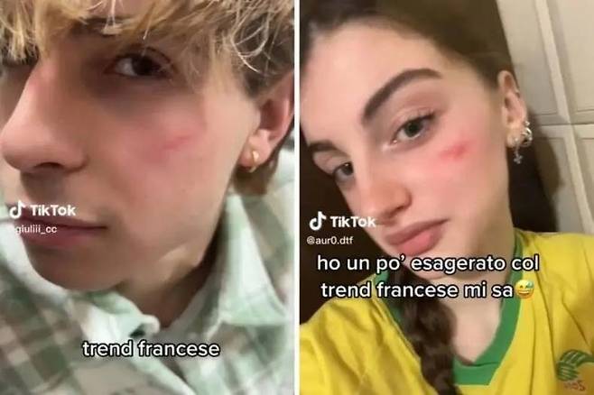 이탈리아 10대들 사이에서 유행 중인 '프렌치 흉터 챌린지' / 사진 출처=틱톡 갈무리