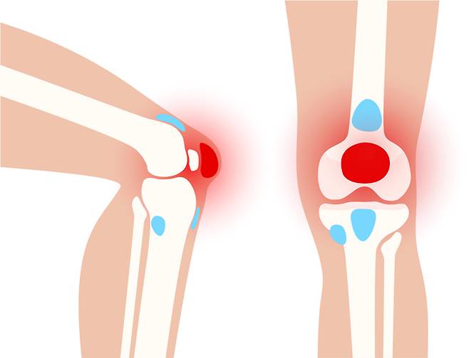 관절은 2개 이상 뼈가 서로 만나는 부분이다. 갑작스러운 운동 등은 관절에 무리를 준다. 특히 무릎을 심하게 굽히는 쪼그려앉기, 낮은 곳에서 일어나기 등은 슬개대퇴관절에 통증을 유발할 수 있다. [사진=게티이미지뱅크]