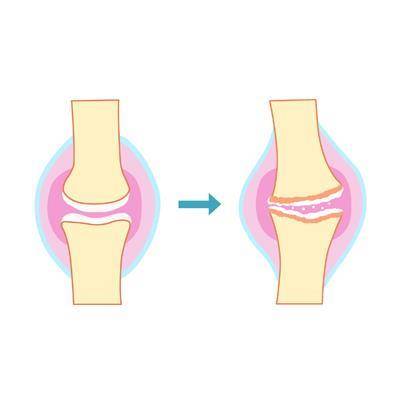 퇴행성 관절염 [출처: 삼성서울병원]