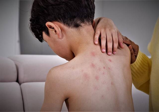 발진이란 피부의 정상적인 모습과 달리 피부의 색깔이 변하거나 부어오른 증상을 의미한다. 이미지투데이