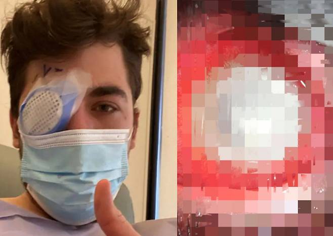 가시아메바에 감염돼 실명하게 된 마이크 크럼홀츠(21), 염증으로 붉게 충혈된 마이크의 각막. 동공이 있어야 할 부분도 흰색으로 변한 모습이다. [마이크 크럼홀츠 틱톡]