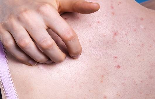 등 여드름은 다양한 원인에 의해 생길 수 있다｜출처: 게티이미지뱅크