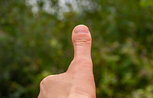 엄지손가락 단지증ㅣ출처: 게티이미지뱅크