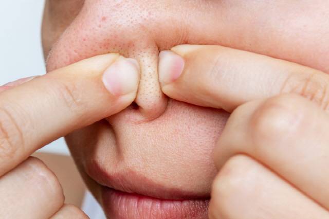 블랙헤드, 귀지, 흰머리는 가급적이면 직접 제거하지 않는 게 좋다./사진=게티이미지뱅크