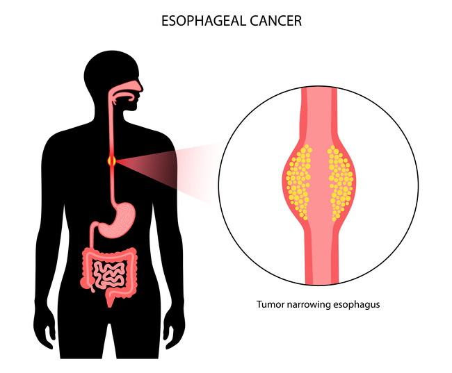 식도암 [사진=게티이미지뱅크]