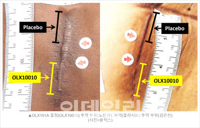 올릭스의 비대흉터치료제 ‘OLX101A’와 위약을 투여한 모습 (사진=올릭스)