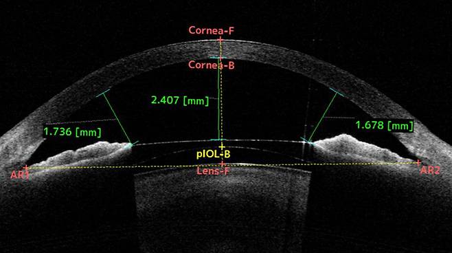 안구 공간 측정ㅣ출처:비앤빛강남밝은세상안과