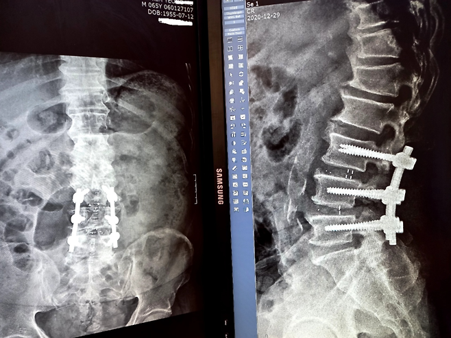 해당 병원에서 척추 수술받은 김 모 씨=출처:김 모 씨 본인