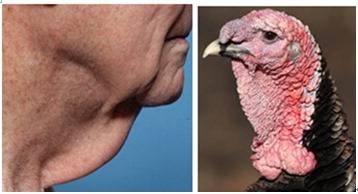 목의 피부와 근육의 처짐이 심한 것을 '칠면조 목(turkey neck)'이라고 한다.