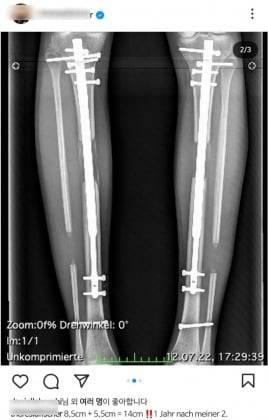 SNS에 '사지 연장술' 후기 사진을 올린 모델. /사진=테레지아 피셔 인스타그램 캡처