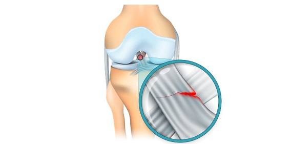 전방십자인대파열. 출처: 게티이미지뱅크