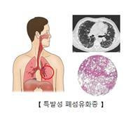 특발성 폐섬유화증 [출처: 서울아산병원]