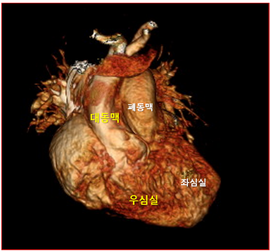 [사진 2] 뒤바뀌어 연결된 대동맥과 폐동맥.