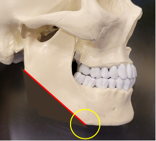 흔히 '개턱'이라 부르는는 턱선 [사진=박준규 원장]