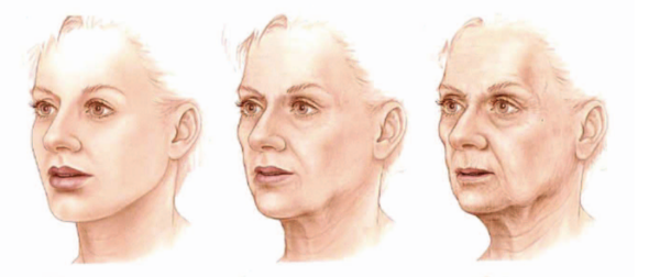 개턱에서 살이 흘러내리는 느낌은 노화와 비슷한 양상입니다. (이미지 출처 Aesthet Surg J. 2006;26:S4 Sydney R Coleman, Rajiv Grover )