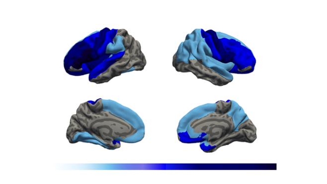 우울증 환자는 뇌 특정 부분 주름 수가 적은 것으로 나타났다. 사진은 대뇌 바깥쪽(위)과 안쪽(아래) 차이를 비교한 모습. 짙은 파란색일수록 뇌 주름의 정도가 감소돼 있음을 의미한다. (고대안암병원 제공)