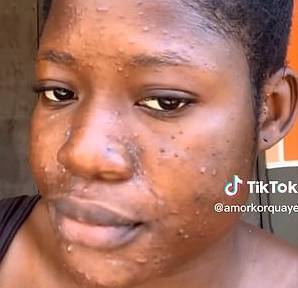 3만7000여 명 팔로워를 지닌 틱톡커가 얼굴의 솜털을 깎은 뒤 부작용이 생겼다. [사진=틱톡 / @amorkorquaye]