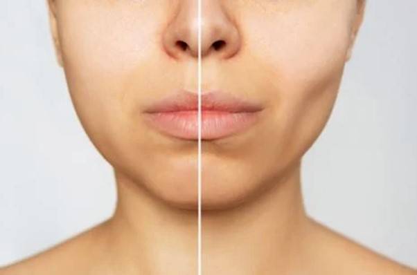 심부볼 지방제거의 느낌. [사진=insider.com 제공]