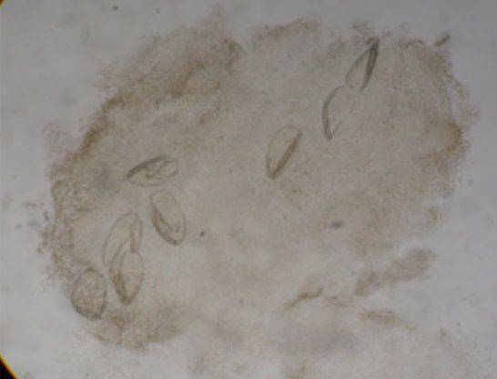 피부확대경으로 본 옴진드기. /대한피부과학회